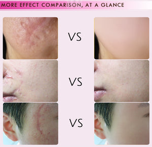 Intense Scar Removal Treatment (Works on Acne Scars Too)